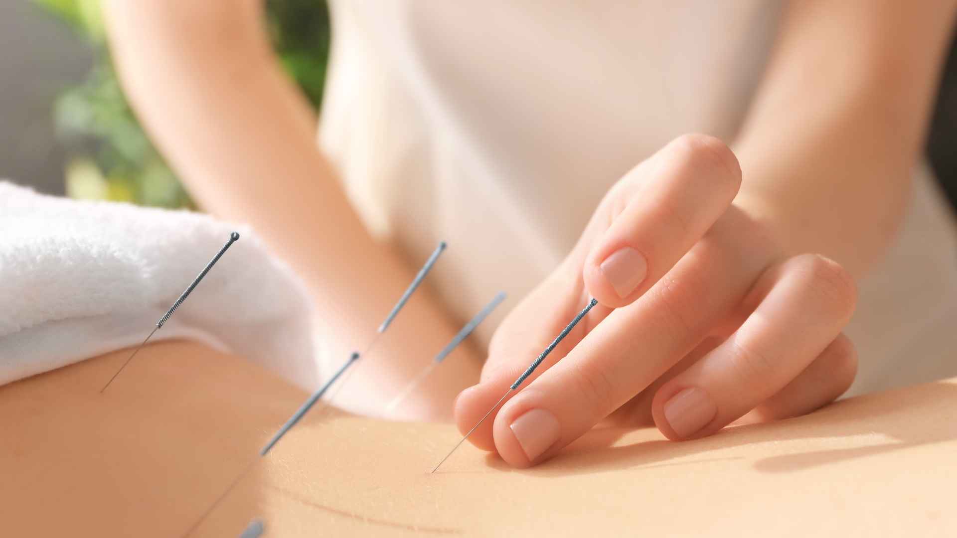 Acupuntura